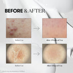 Reedle Shot 100 Micro-needle Face Booster